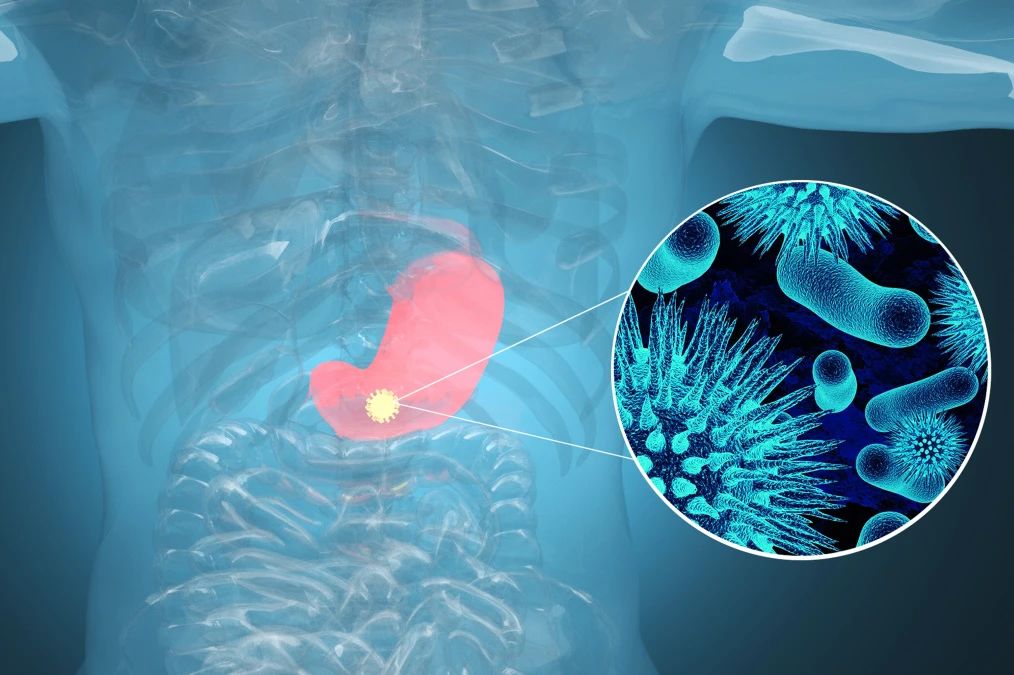 腫瘤標(biāo)記物CA72-4：“胃”，你還好嗎？
